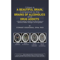 I Have a Beautiful Brain, Compared to the Brains of Alcoholics and Drug Addicts