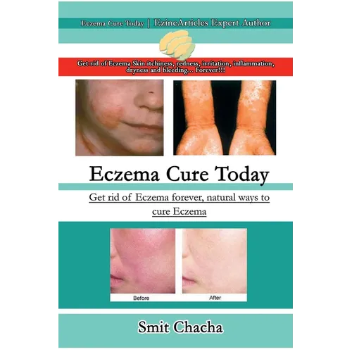 Eczema Cure Today - Get rid of Eczema forever natural ways to cure Eczema